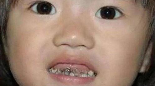 老王吃瓜牙流血,揭秘瓜果安全食用指南