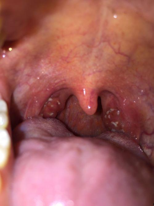 吃瓜囊后喉咙,一场味蕾与健康的邂逅