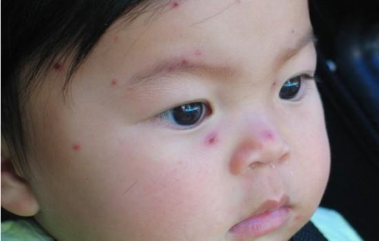 水痘可以吃瓜吗,可以吃瓜吗？